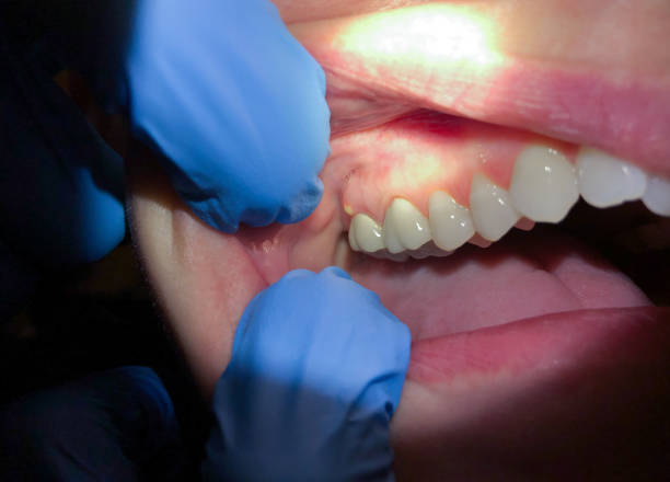 Best Emergency Wisdom Teeth Removal in Wheaton, MD
